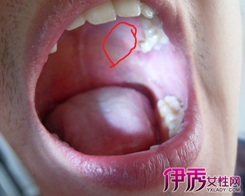 【图】口腔念珠菌感染图片展现 盘点此病的病因及临床症状