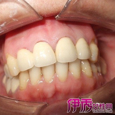 【图】带你了解牙齿打桩的过程 揭示牙齿打桩的弊端