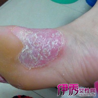【图】脚皮肤病的种类图片欣赏 给你介绍三种类型的皮肤病