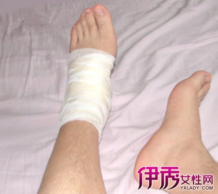 【图】运动时脚扭伤可以用热水泡吗 七个步骤教你治好脚伤
