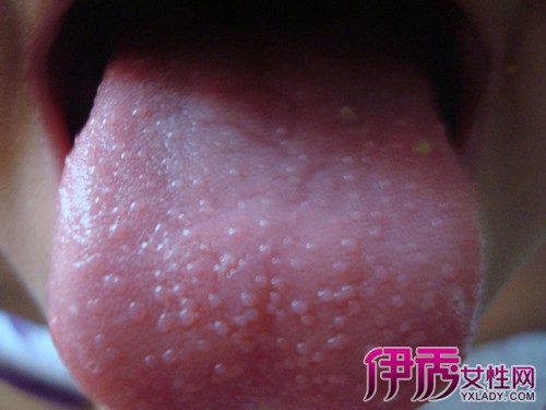 【图】舌乳头炎的症状介绍 其各种临床病症介绍