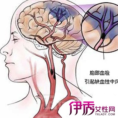 脑血管硬化不能吃什么