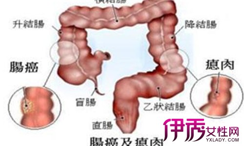 揭秘结肠癌晚期 五个表现教你辨别结肠癌晚期