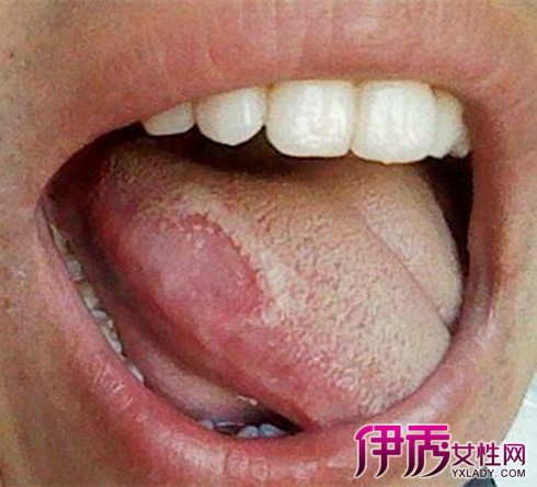 【图】艾滋病舌头溃疡图片展示 3中该病的溃疡类型大曝光
