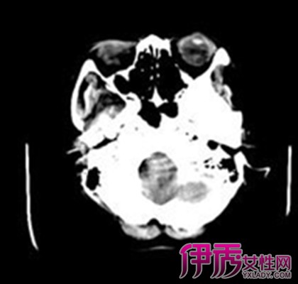 【大面积脑梗塞危险期】【图】小编揭秘大面积