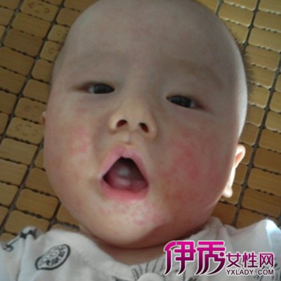 【荨麻疹 症状】【图】小儿荨麻疹的症状有哪