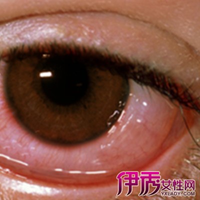 【图】眼睛患了结膜炎怎么办 结膜炎的2种症状体现你知道吗