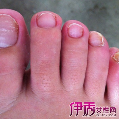 【灰指甲轻微症状图片】【图】展示灰指甲轻微