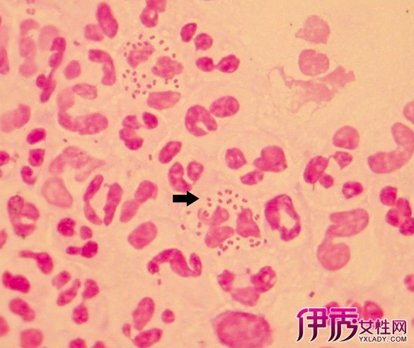 【图】女性霉菌感染图有哪些 教你十招防霉菌感染