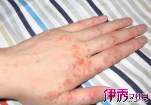 【图】干性湿疹是什么引起的 干性湿疹的治疗及其注意事项