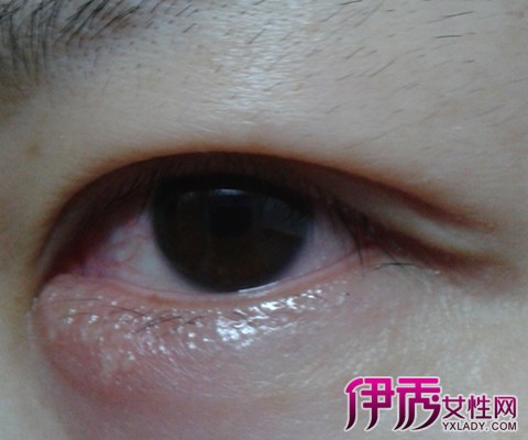 【图】内眼角红肿是什么原因 如何快速有效治疗眼睛红肿