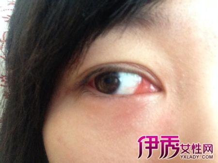 【图】内眼角红肿是什么原因 如何快速有效治疗眼睛红肿