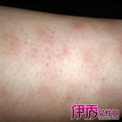 【图】小腿丹毒的症状图片一览 有可能是丝虫病引起