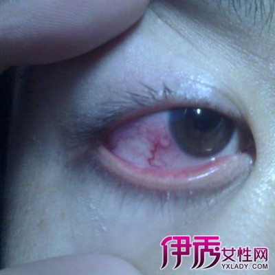 【图】泡性结膜炎图片展示 莫耽误病情需时刻关注眼睛变化