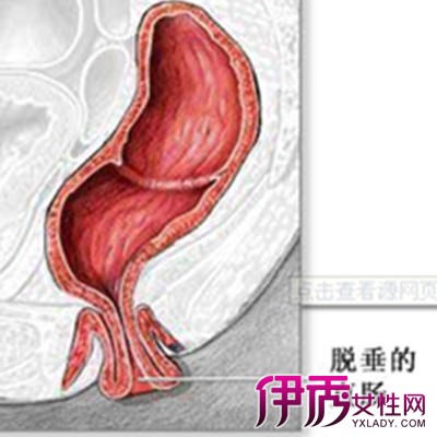 脱肛的原因是什么 如何进行检查和预防呢