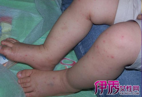 药物疹的症状图片 如何预防和治疗药物疹