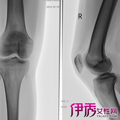 【图】膝盖后面的腘窝疼痛是怎么回事 找出病因并对症治疗