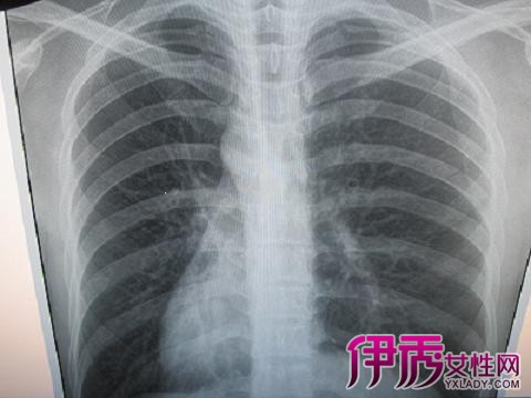【肺纹理增多是怎么回事】【图】肺纹理增多是