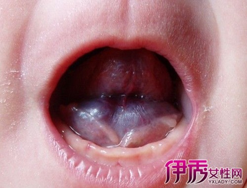 【舌头下面血管瘤】【图】盘点舌头下面血管瘤