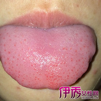 【图】揭秘舌头起红点是怎么回事 3个方面告诉你舌头红点的原因
