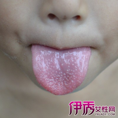 【图】舌苔黄的原因有哪些 舌苔发黄与什么疾