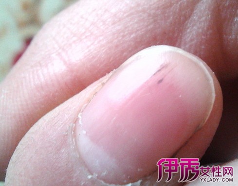 指甲有血丝是怎么回事 观察指甲的变了解身体病征