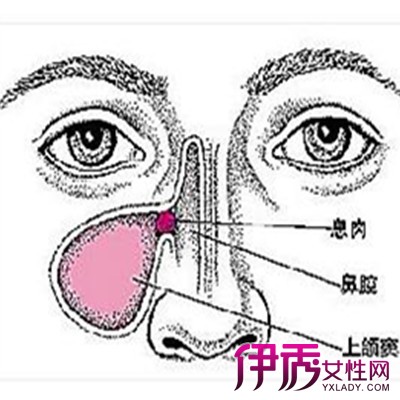 【鼻咽癌的早期症状图片】【图】鼻咽癌的早期