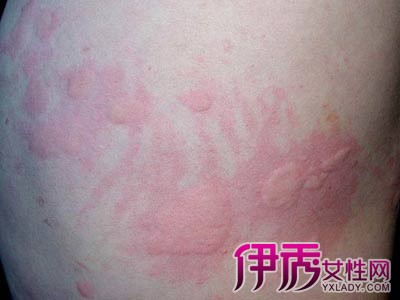 血热湿疹皮肤病图片展示 介绍3种不同的治疗方法