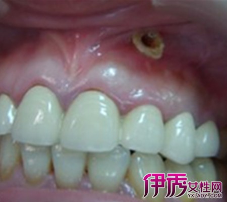 【牙槽脓肿】【图】牙槽脓肿怎么办 预防治疗