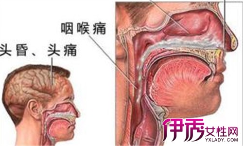 鼻窦囊肿症状有哪些 揭秘鼻腔囊肿的三大症状