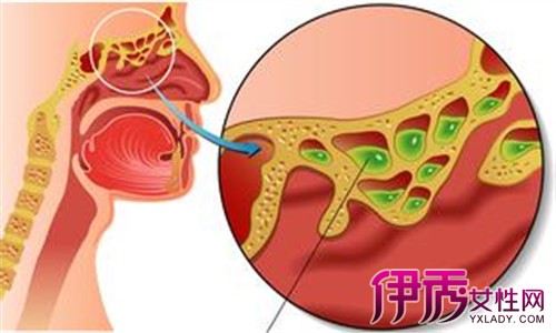 2,一侧鼻翼附着处隆起,触及弹性而柔软的肿块; 3,合并感染则鼻腔囊肿