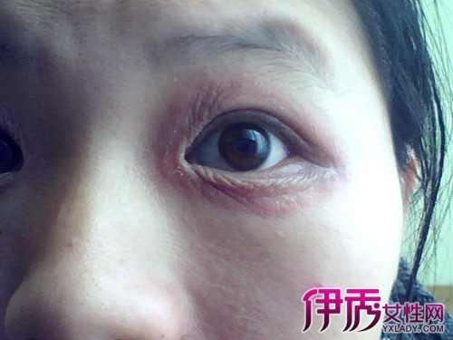 图】眼睛眼皮上痒红肿是什么问题 几种眼部红