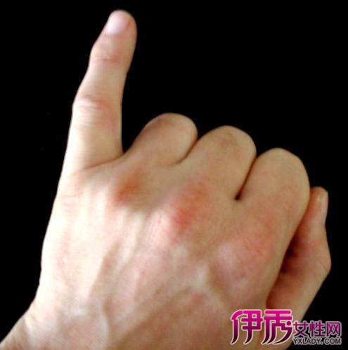 手指类风湿症状是怎样 手指类风湿应注意什么