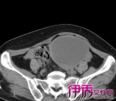 【盆腔包块是什么】【图】解答盆腔包块是什么
