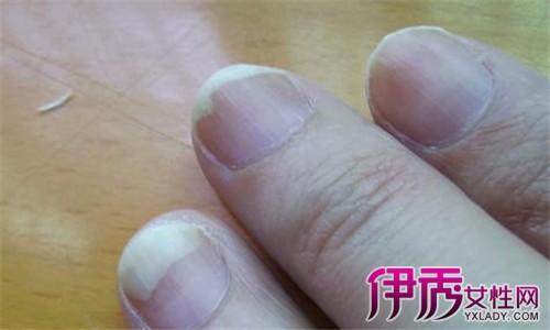 【图】慢性灰指甲图片大全告诉你灰指甲的六大