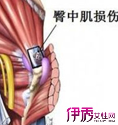 【图】臀中肌疼痛是怎么回事 臀中肌损伤不可忽视的小问题