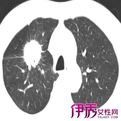 【小细胞肺癌会传染吗】【图】小细胞肺癌会传