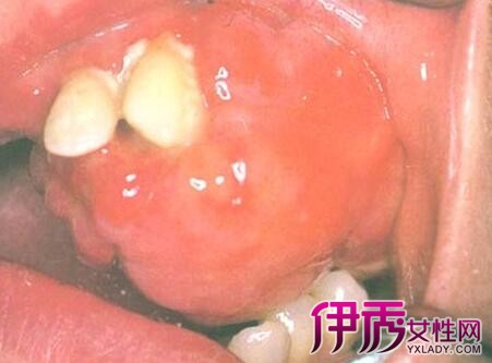 智齿后面牙龈长肉芽怎么办 佳方案告诉你