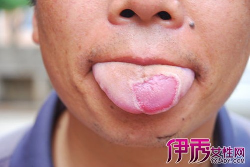 及治疗 地图舌是一种原因不明的良性,慢性,浅表性,剥脱性局限性舌炎