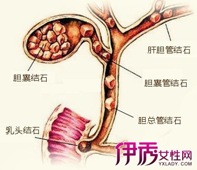 【图】胆结石胆囊炎吃什么好呢 几大膳食原则必须遵守