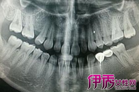 【图】牙根囊肿会恶变吗 那些让你不得不了解的牙龈囊肿常识