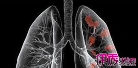 【肿瘤与癌症区别】【图】肺肿瘤与癌症区别是