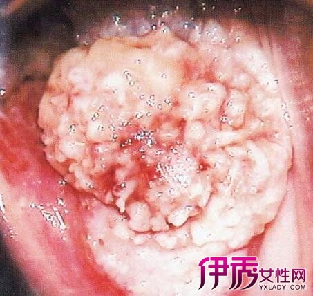 【宫颈癌症状有哪些】【图】宫颈癌症状有哪些