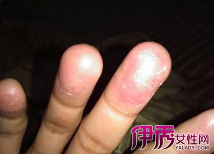 【图】手指真菌感染脱皮怎么办 推荐3大快速有效治疗方法