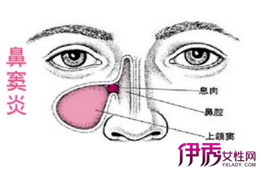 【得了鼻窦炎怎么办】【图】得了鼻窦炎怎么办