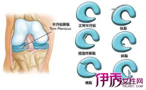健康 / 正文  半月板:半月板是2个月牙形的纤维软骨,位于胫骨平台内侧