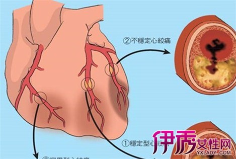 不稳定性心绞痛介入治疗临床路径