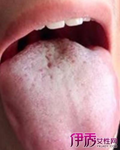 【图】舌头有白斑是不是艾滋病 教你简单辨别方法