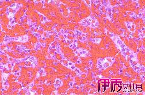 【红细胞增多症诊断标准】【图】红细胞增多症