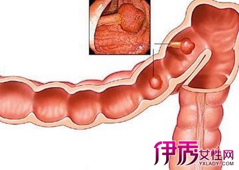 【直肠癌可以活多久】【图】晚期直肠癌可以活